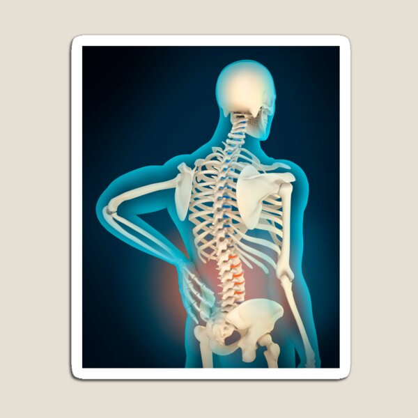 Medical illustration showing inflammation in human back area Magnet