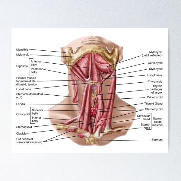 Medical illustration detailing thoracic outlet syndrome. Poster