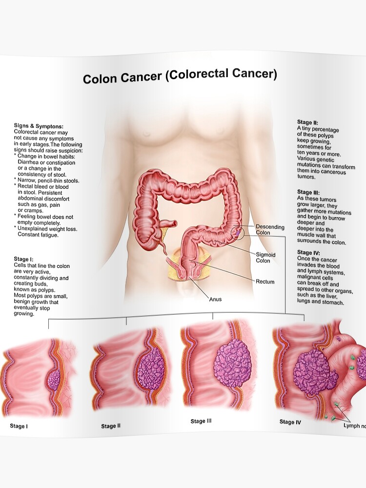 Tumor Sizes Chart Colon