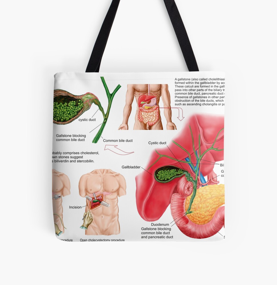 Amazon.com: Support Awareness Squad I Cholecystectomy Gallbladder Cancer Tote  Bag : Clothing, Shoes & Jewelry