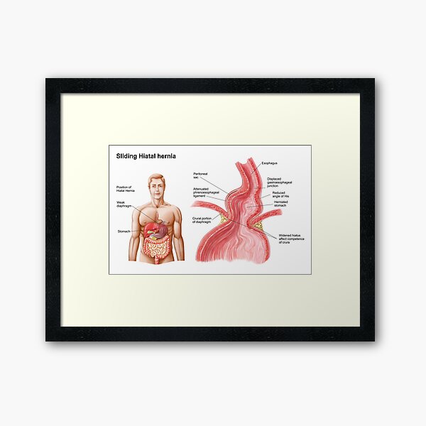 Aperçu de l'œuvre Illustration médicale d'une hernie hiatale dans la partie supérieure de l'estomac dans le thorax. créée et vendue par StocktrekImages.