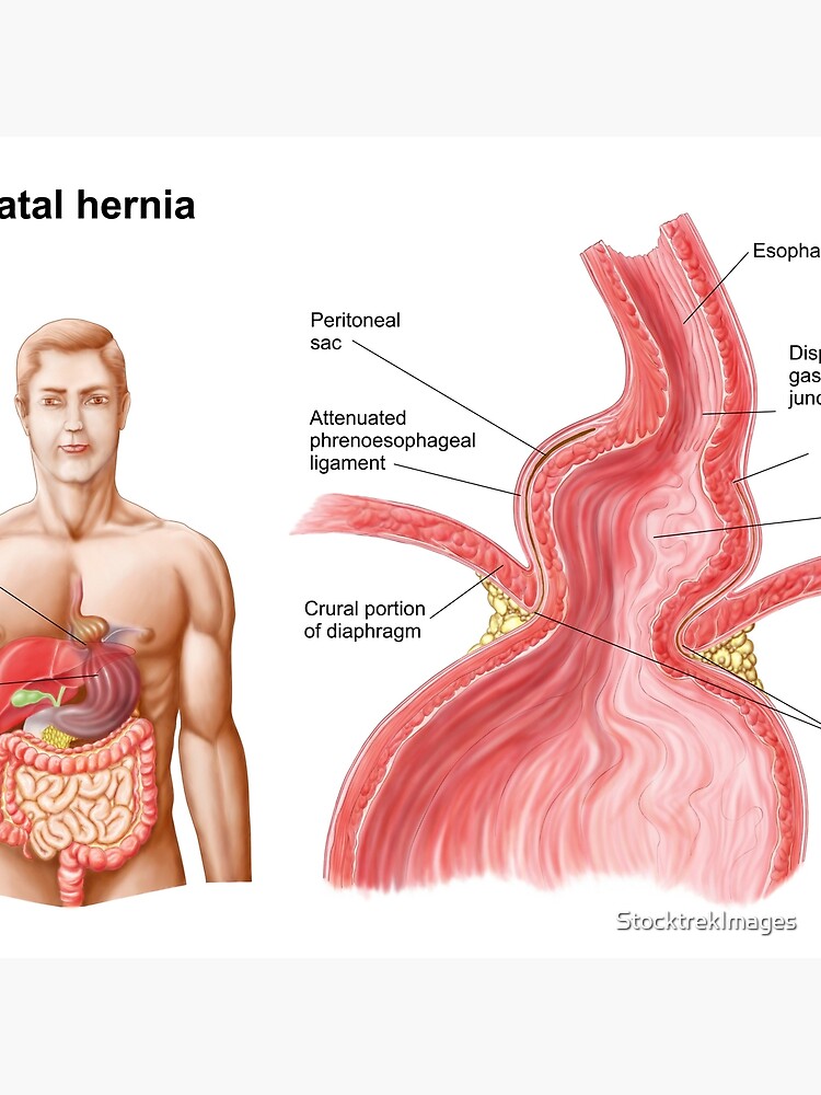 Hiatal clearance hernia pillow