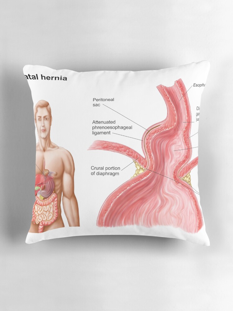 Medical illustration of a hiatal hernia in the upper part of the stomach into the thorax. Pillow for Sale by StocktrekImages Redbubble