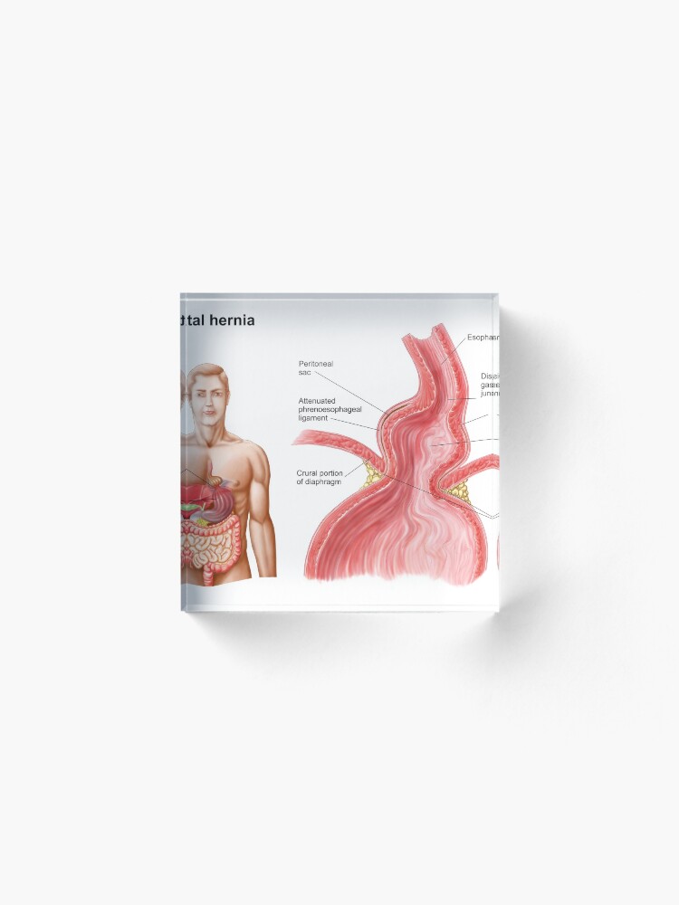 Medical Illustration Of A Hiatal Hernia In The Upper Part Of The