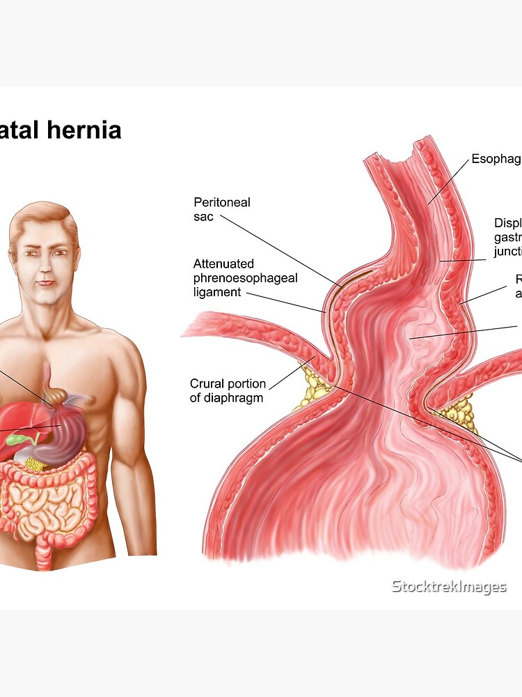 Medical Illustration Of A Hiatal Hernia In The Upper Part Of The Stomach Into The Thorax