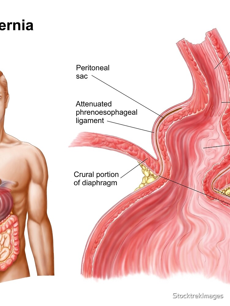 "Medical illustration of a hiatal hernia in the upper part of the