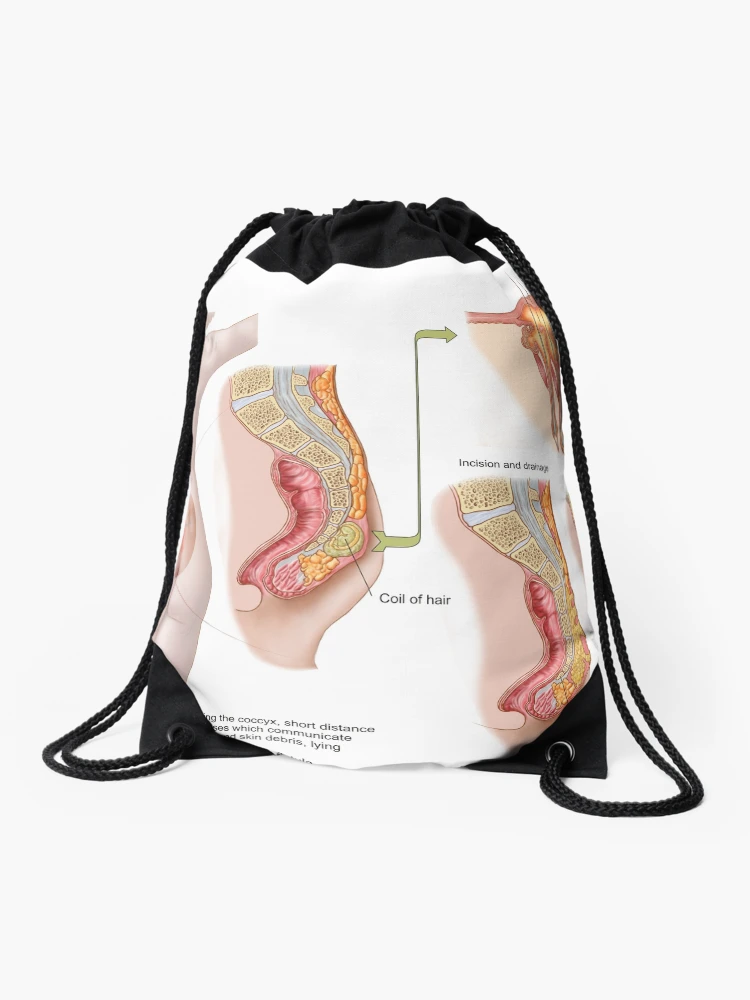Mochila saco for Sale con la obra «Ilustración médica de un quiste