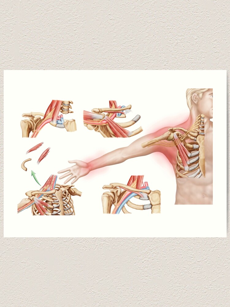 Medical Illustration Detailing Thoracic Outlet Syndrome Art Print By