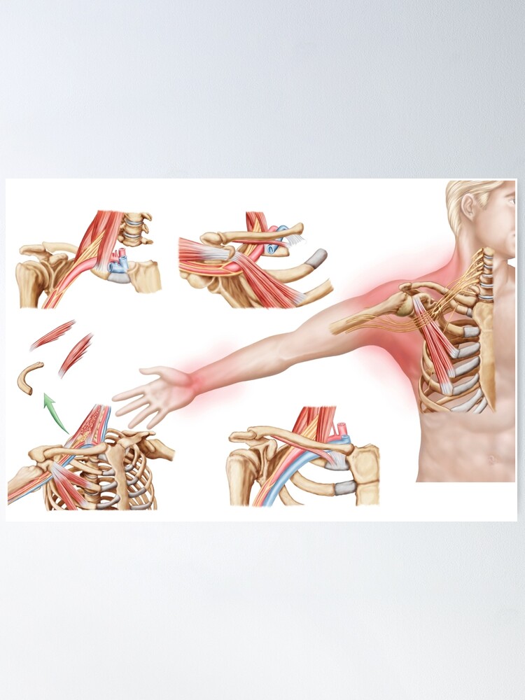 Medical illustration detailing thoracic outlet syndrome. Drawstring Bag  for Sale by StocktrekImages