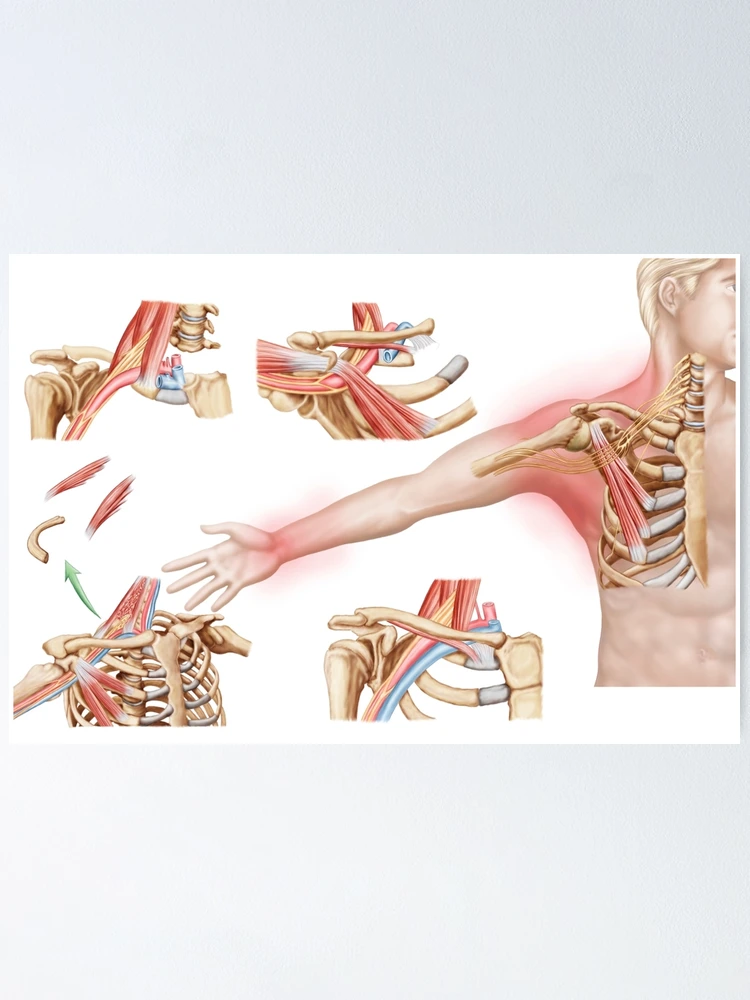 Medical illustration detailing thoracic outlet syndrome Stock