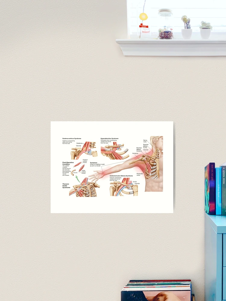 Medical illustration detailing thoracic outlet syndrome Stock