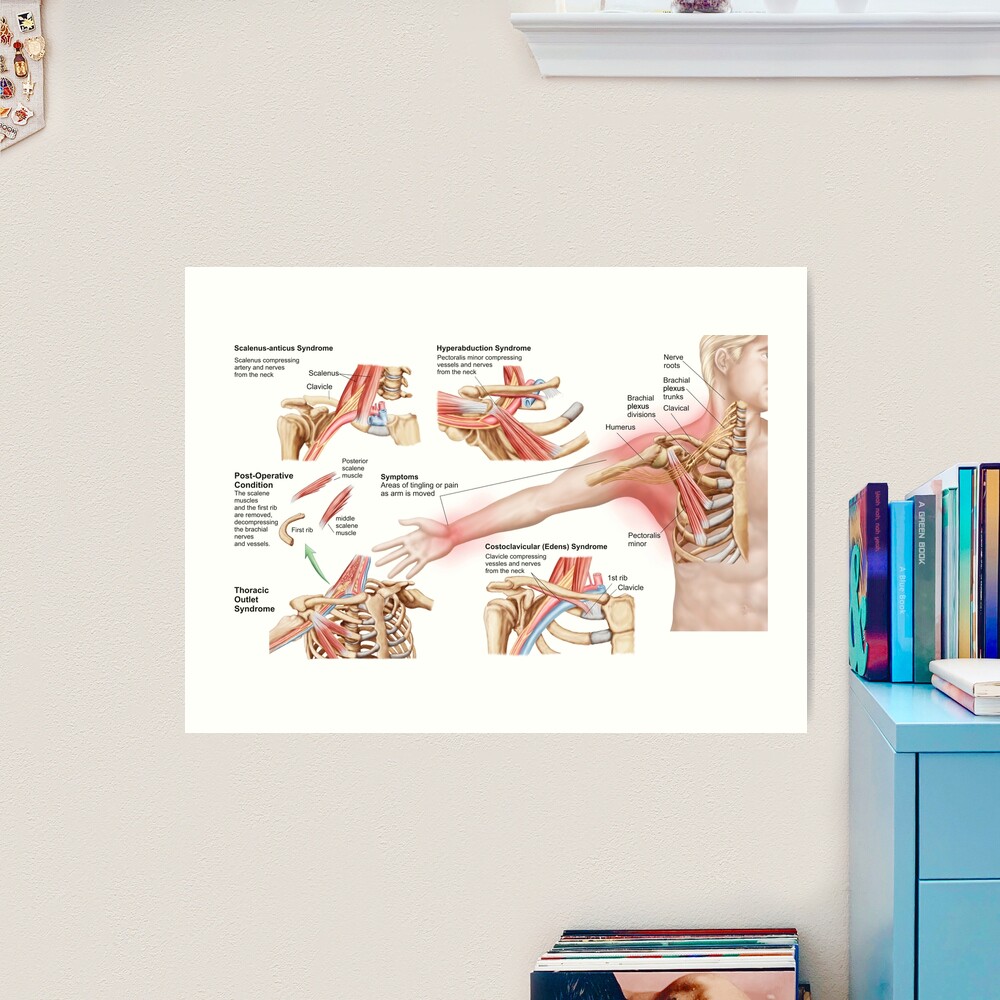 Medical illustration detailing thoracic outlet syndrome Stock