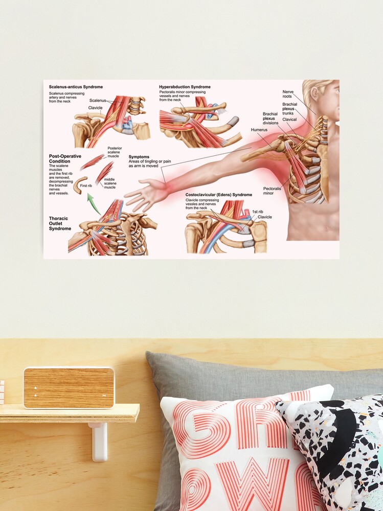 Medical illustration detailing thoracic outlet syndrome. Poster