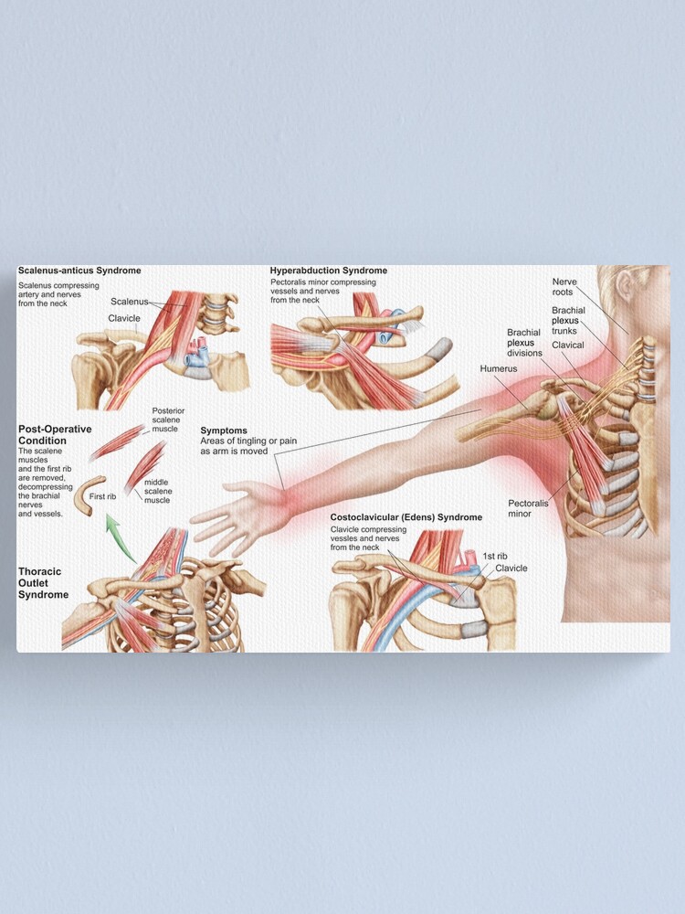 Medical illustration detailing thoracic outlet syndrome. Poster for Sale  by StocktrekImages