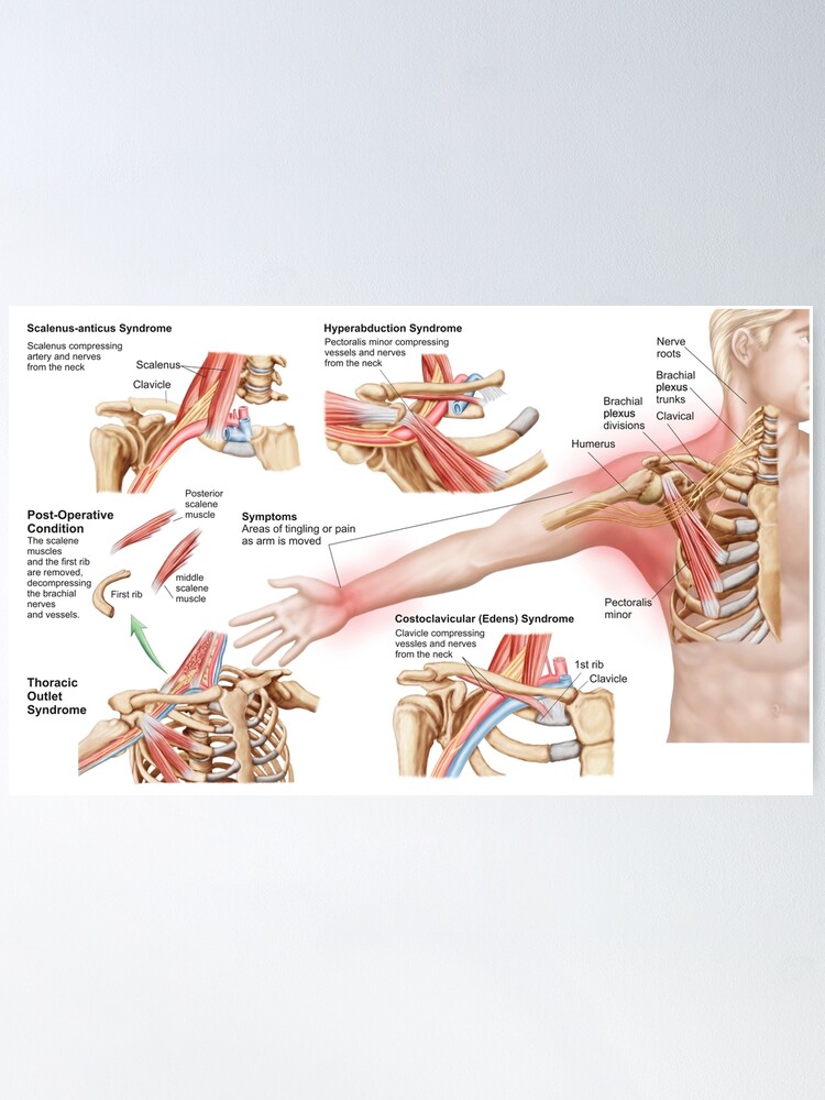 Medical illustration detailing thoracic outlet syndrome. Poster for Sale  by StocktrekImages