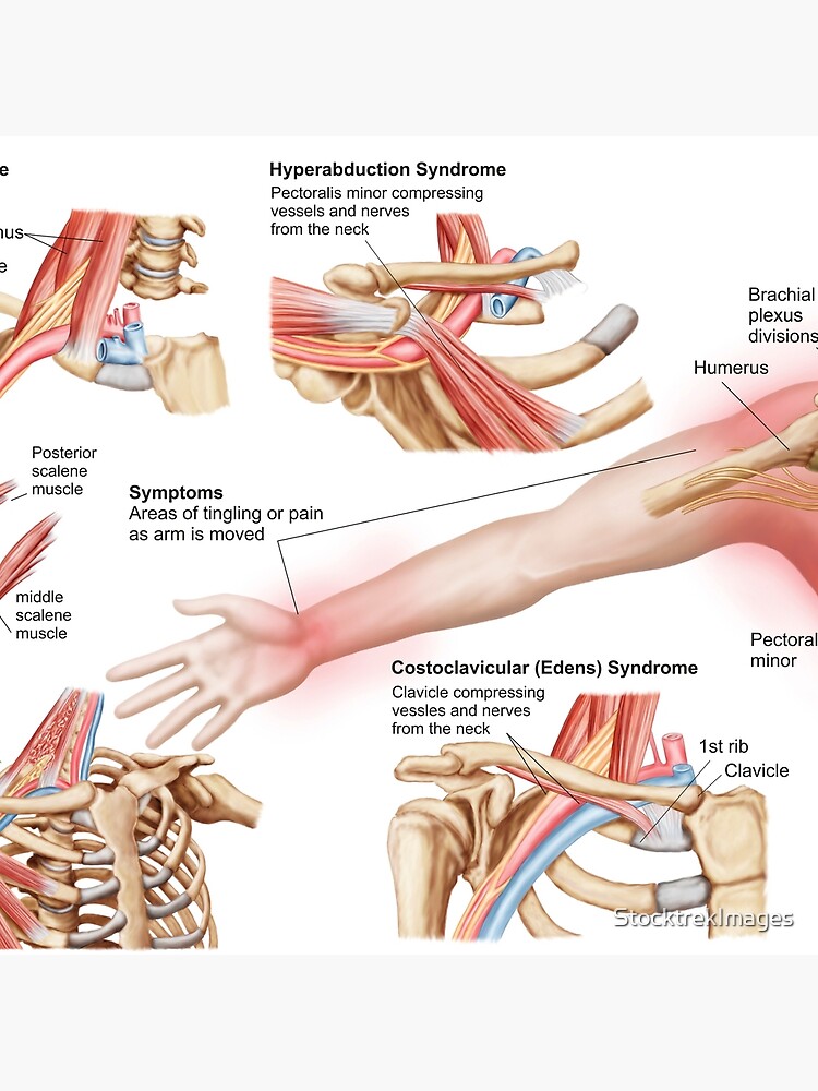 Medical illustration detailing thoracic outlet syndrome. Throw