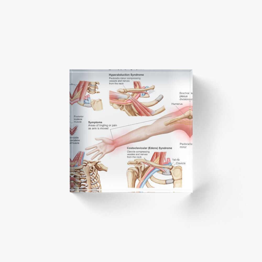 Medical illustration detailing thoracic outlet syndrome. Poster