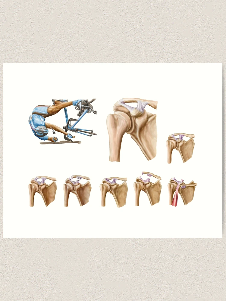 Lámina artística for Sale con la obra «Anatomía de la rotura y