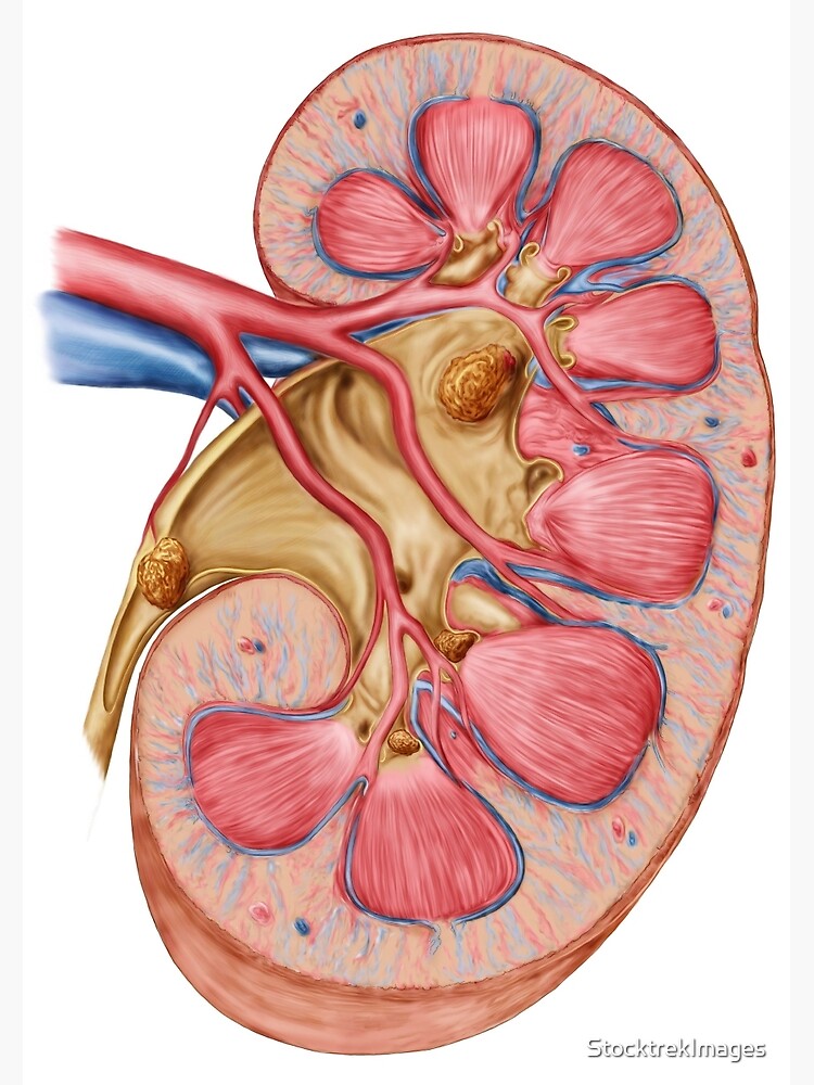 calculus of kidney