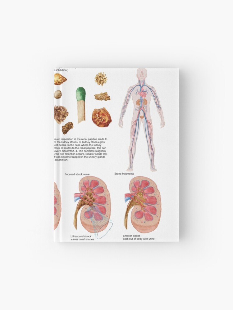 calculo renal signos y sintomas