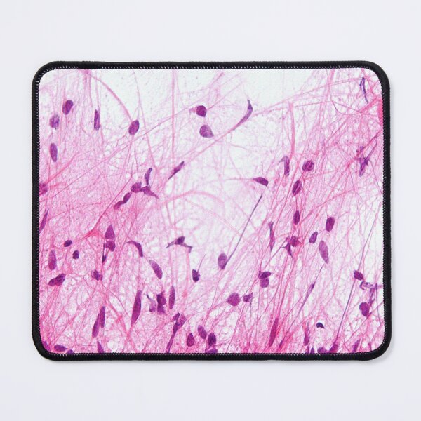 Item preview, Astrocytoma Histology designed and sold by deltoid.