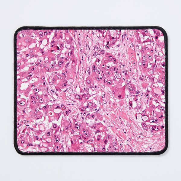 Item preview, Liver Cancer Histology designed and sold by deltoid.