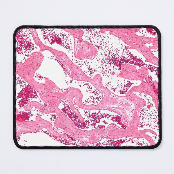Item preview, Liver Disease Histology designed and sold by deltoid.