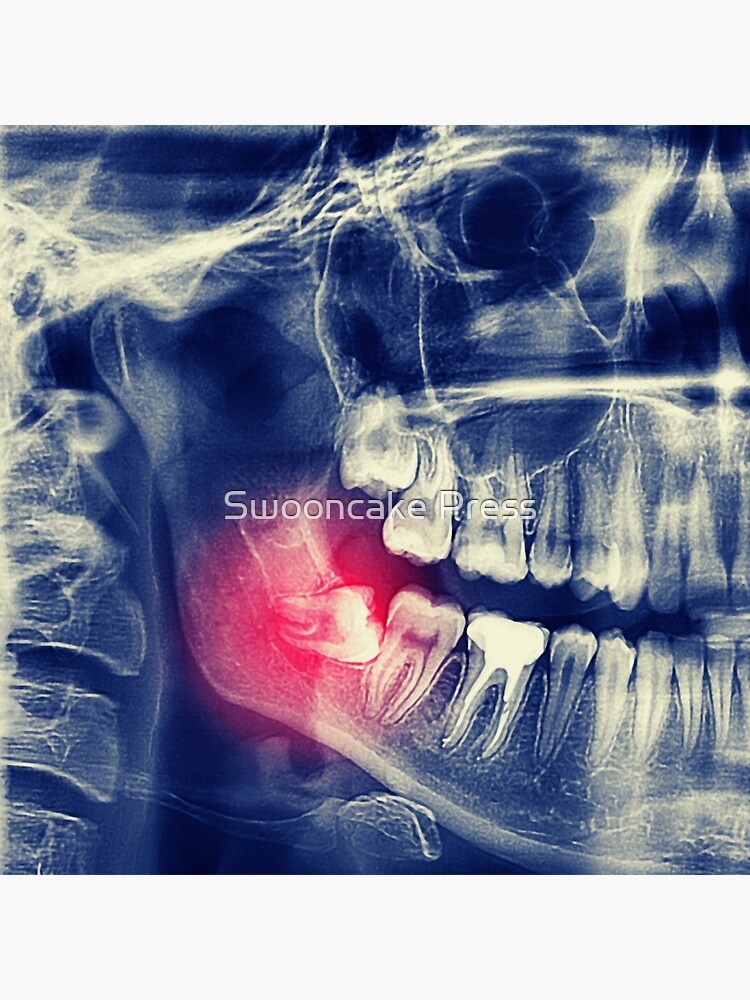 "DENTAL XRAY" Poster for Sale by mistivelvet Redbubble