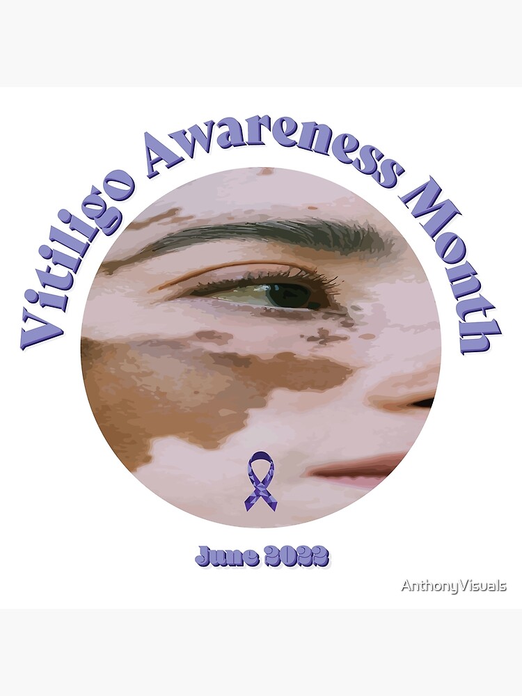 "Vitiligo Awareness Month " Poster for Sale by AnthonyVisuals Redbubble