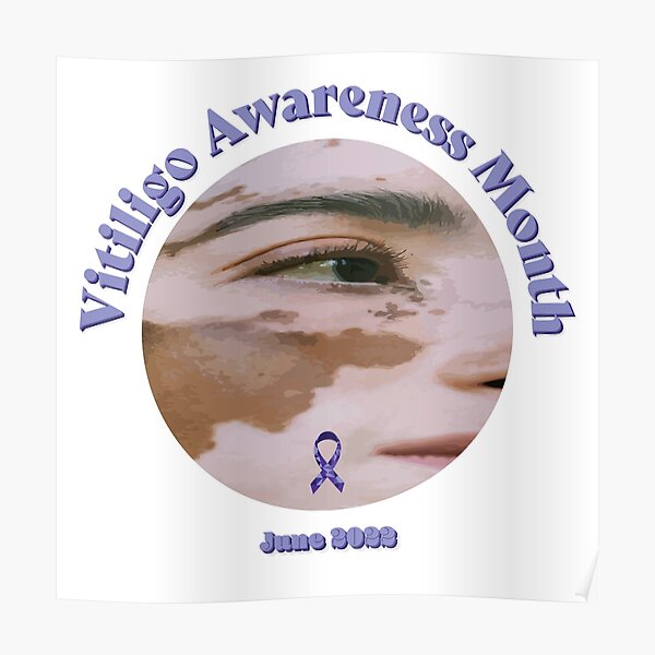 Vitiligo Awareness Month Poster For Sale By Anthonyvisuals Redbubble 7986