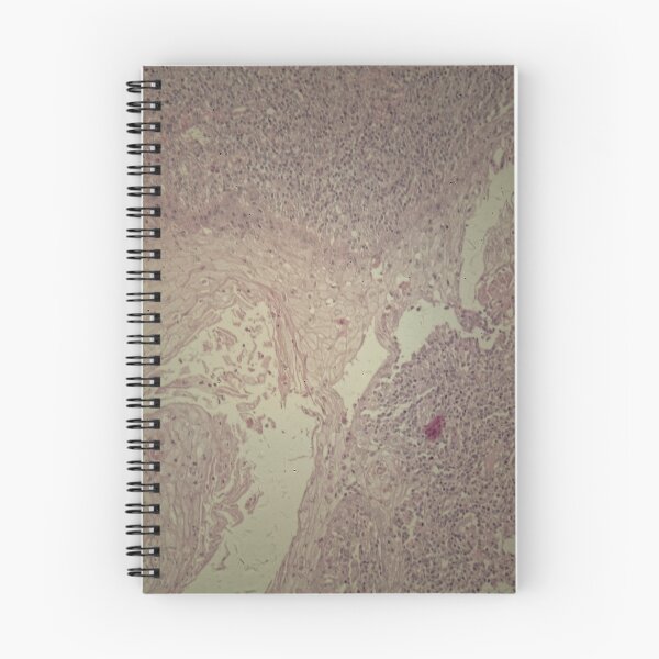 Item preview, Human skin with squamous cell carcinoma designed and sold by Zosimus.