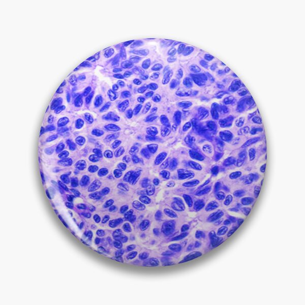 Item preview, Ovarian Dysgerminomas designed and sold by DarkiraVClemm.