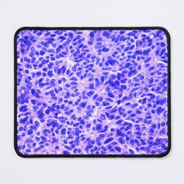 Item preview, Ovarian Dysgerminomas designed and sold by DarkiraVClemm.