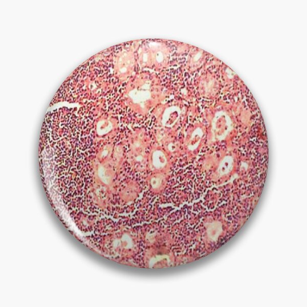 Item preview, Hashimoto's thyroiditis designed and sold by DarkiraVClemm.