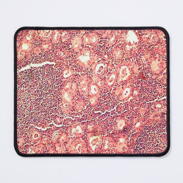 Item preview, Hashimoto's thyroiditis designed and sold by DarkiraVClemm.