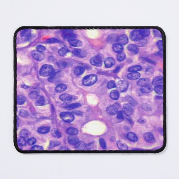 Item preview, Papillary carcinoma designed and sold by DarkiraVClemm.