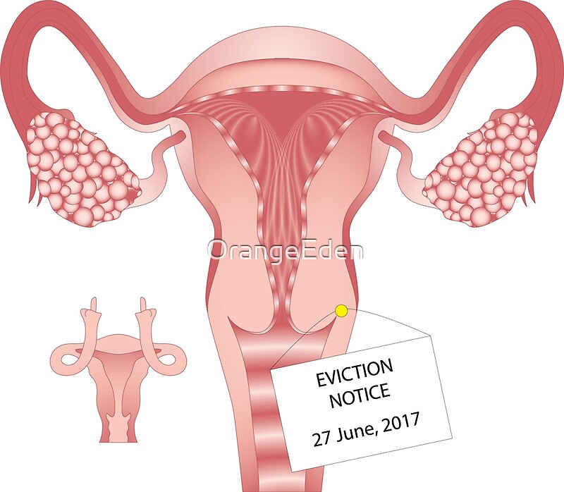 Uterus Eviction Means