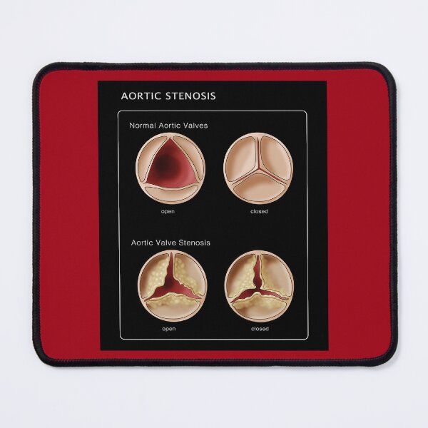 Item preview, Medical Illustration of Heart Valves, Normal & Stenosis designed and sold by ScienceSource.