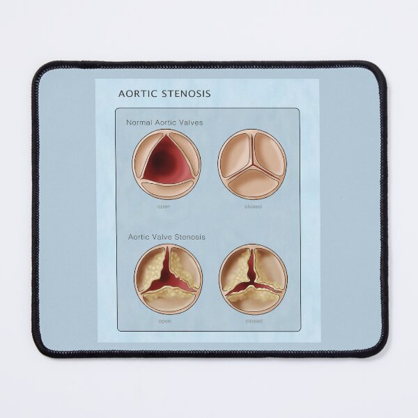 Item preview, Medical Illustration of Heart Valves, Normal & Stenosis designed and sold by ScienceSource.