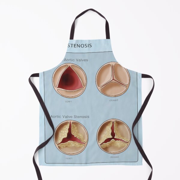 Item preview, Medical Illustration of Heart Valves, Normal & Stenosis designed and sold by ScienceSource.