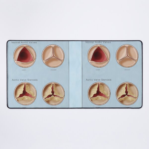 Item preview, Medical Illustration of Heart Valves, Normal & Stenosis designed and sold by ScienceSource.