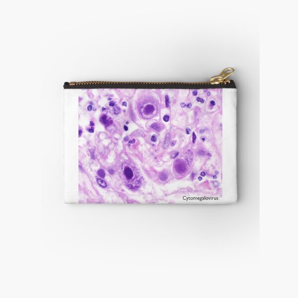 Item preview, Cytomegalovirus in tissue designed and sold by Bobbi Pritt.