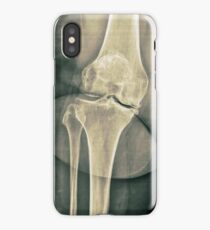 x-ray of the right knee iPhone Case