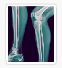 x-ray of the right knee of a 42 year old male Sticker