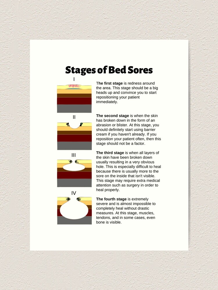 "Stages of Bed Sores Chart" Art Print for Sale by Caregiverology