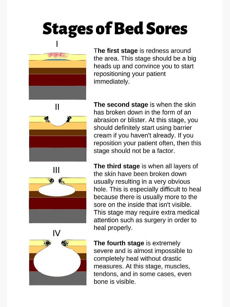 stages-of-bed-sores-chart-canvas-print-for-sale-by-caregiverology