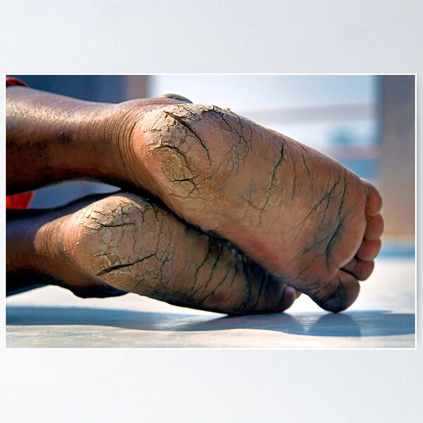 Item preview, Feet Cracks  designed and sold by Momo-Stores.