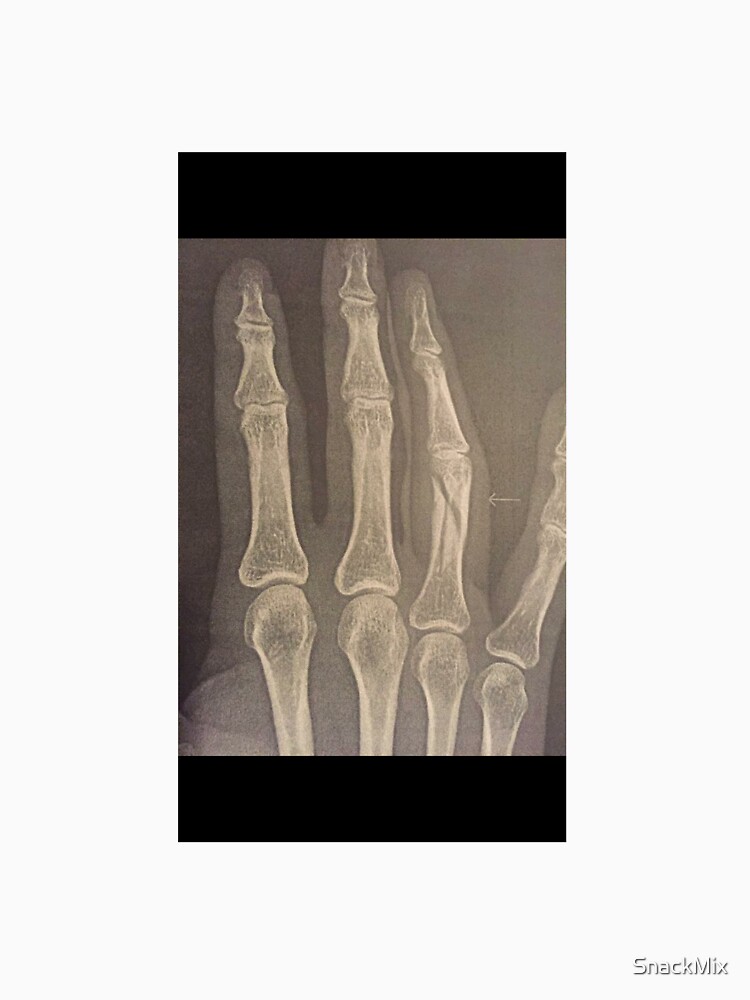 spiral fracture pinky finger