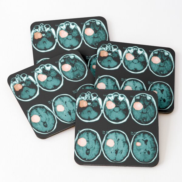 Item preview, MRI scan of a Brain Tumor, Medical Scan designed and sold by ScienceSource.
