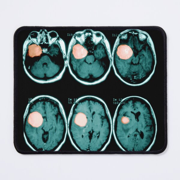 Item preview, MRI scan of a Brain Tumor, Medical Scan designed and sold by ScienceSource.